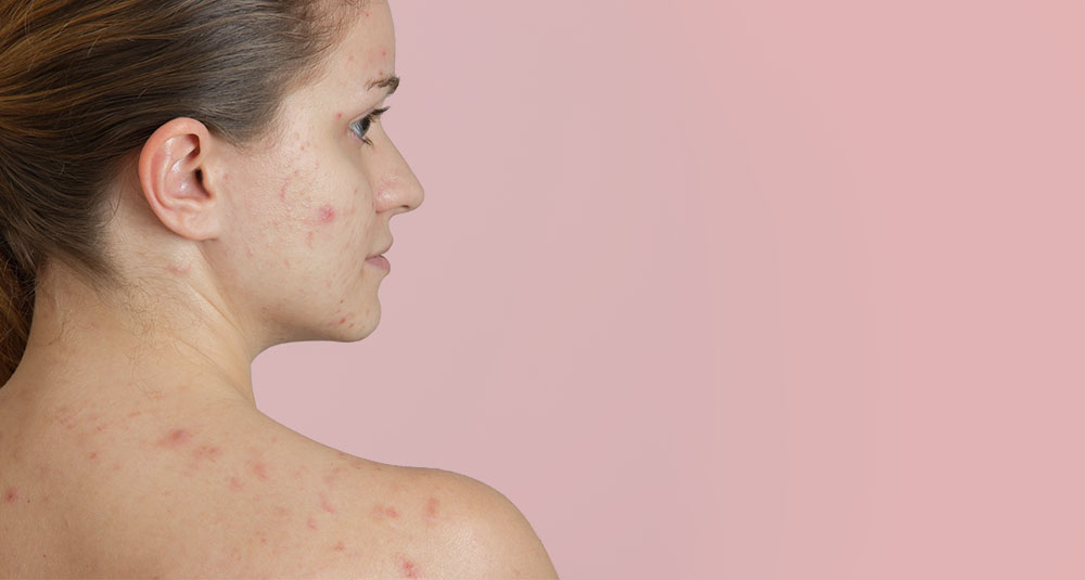 Passou dos 25 e ainda tem acne? Saiba como lidar com as espinhas após a adolescência